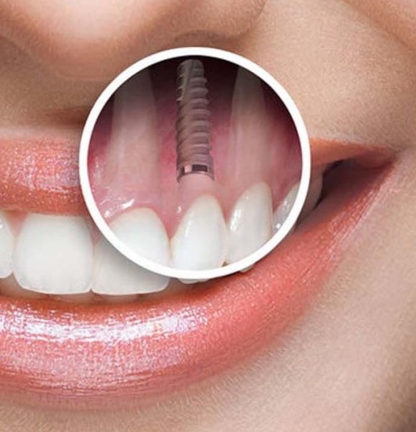 how-long-does-a-dental-implant-take-1536x1024