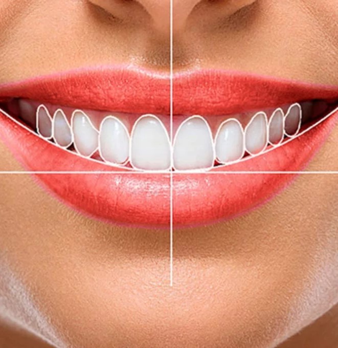 smile-design